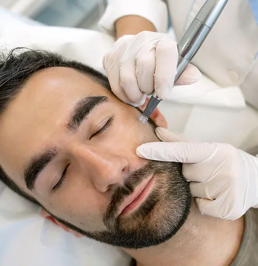 Microneedling-Behandlung